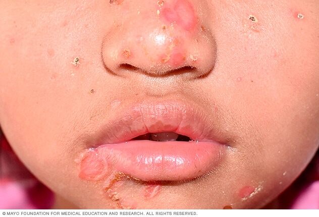 Impetigo on four different skin colors.