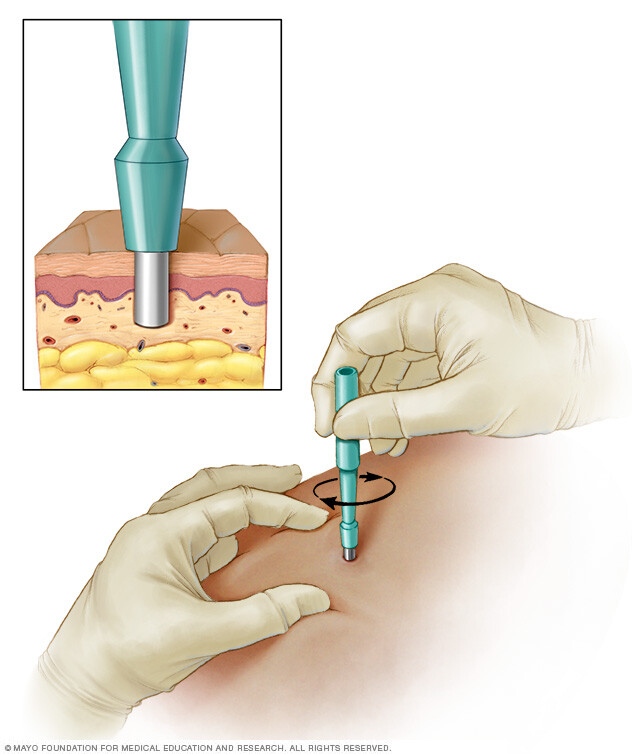 Punch biopsy