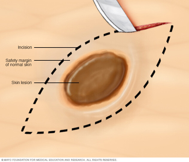 Excisional biopsy of the skin