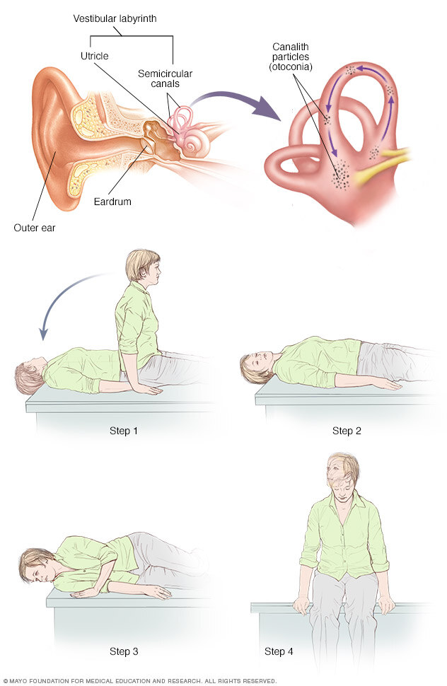 Canalith repositioning procedure