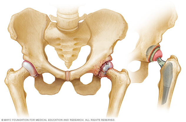 Hip affected by osteoarthritis before and after hip replacement