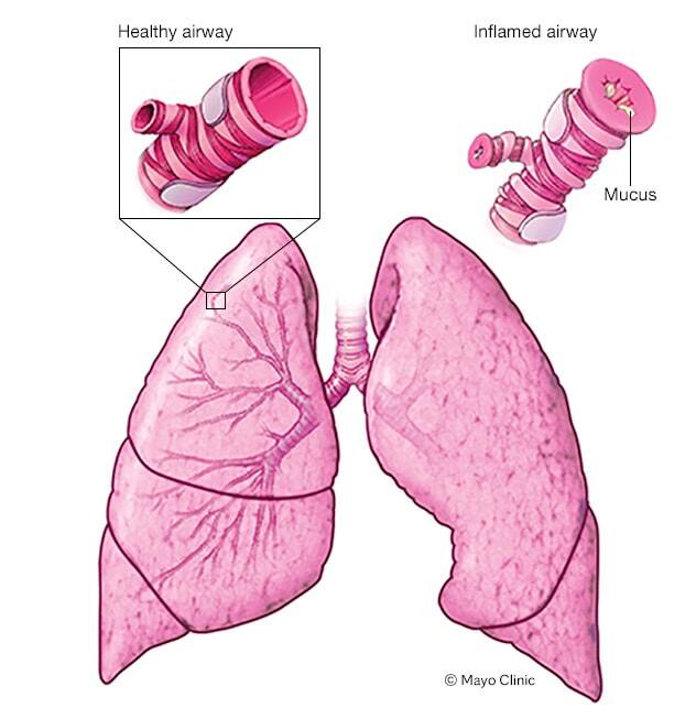 What happens during an asthma attack