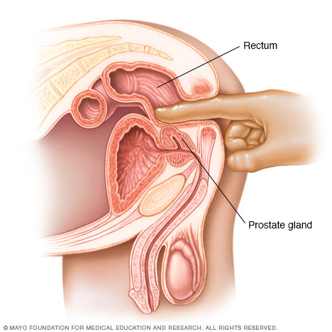 Digital rectal exam 