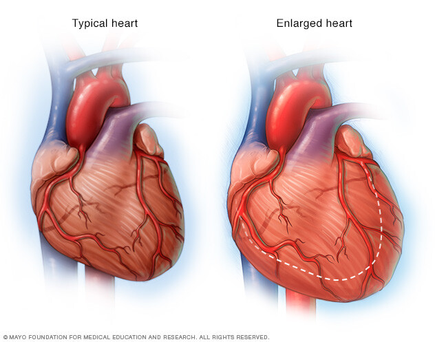 An enlarged heart