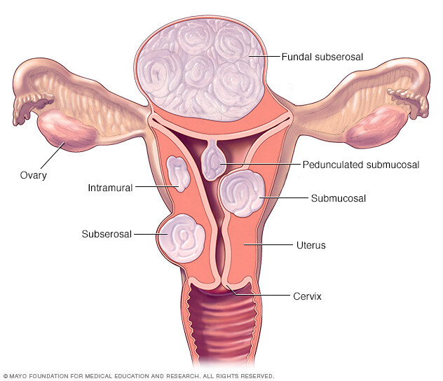 Different types of uterine fibroids and their locations