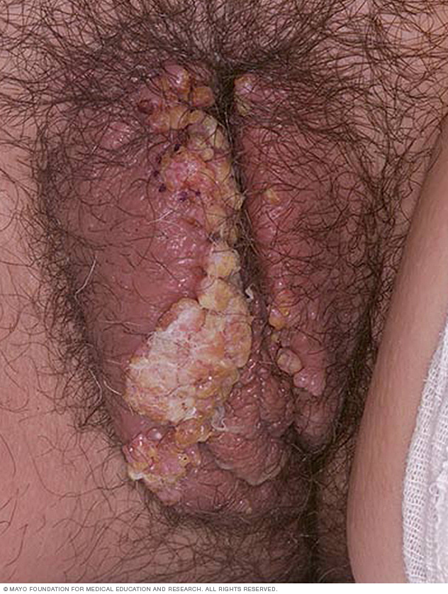 Genital warts in a woman