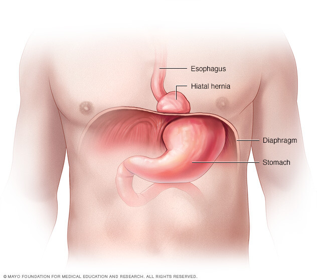 A hiatal hernia