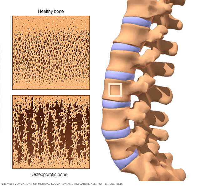 Comparing the interior of a healthy bone with one that has become porous from osteoporosis