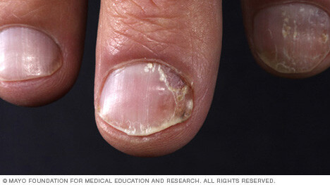 Nail psoriasis