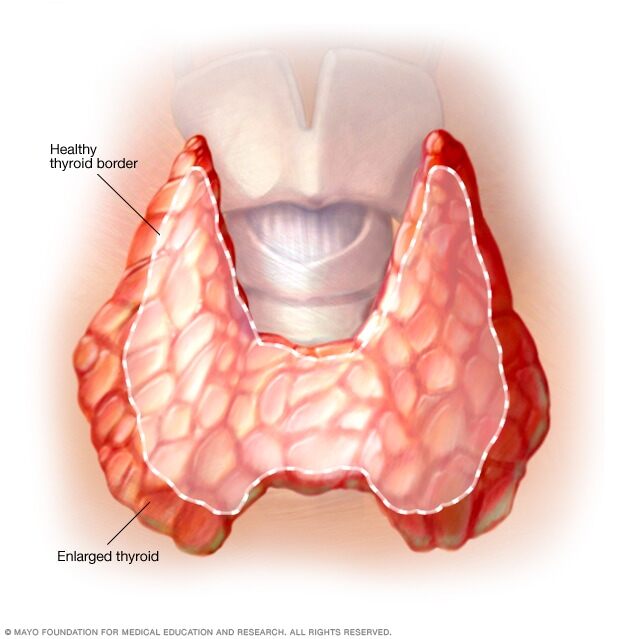 Enlarged thyroid associated with Graves' disease