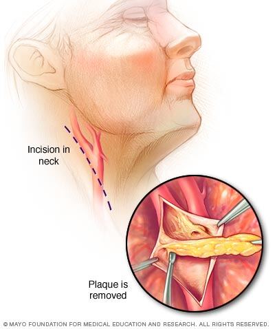 Steps of carotid endarterectomy