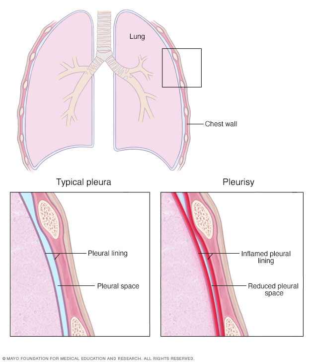 Healthy pleural lining and pleurisy