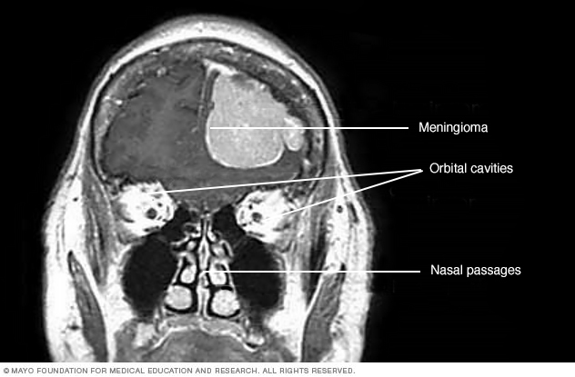 Computerized tomography (CT) scan showing a meningioma