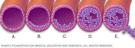 How breast cancer develops