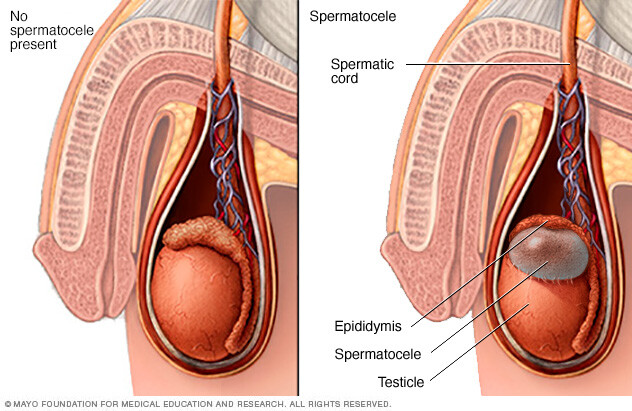 Spermatocele