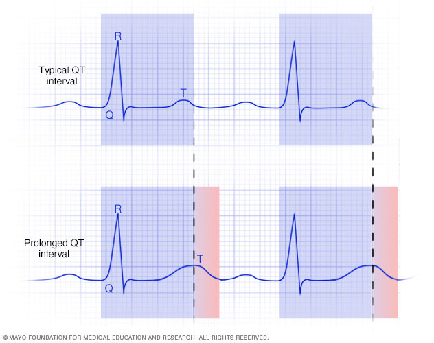 Graphs of typical and prolonged QT intervals