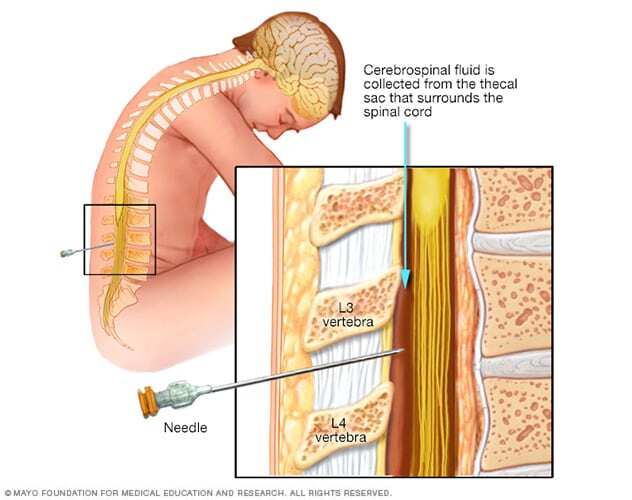 Lumbar puncture, also called a spinal tap