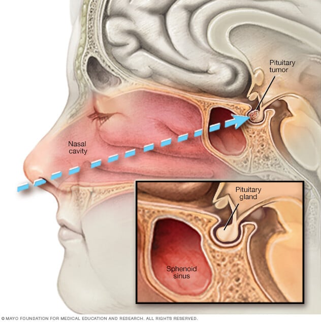 Endoscopic transnasal transsphenoidal surgery