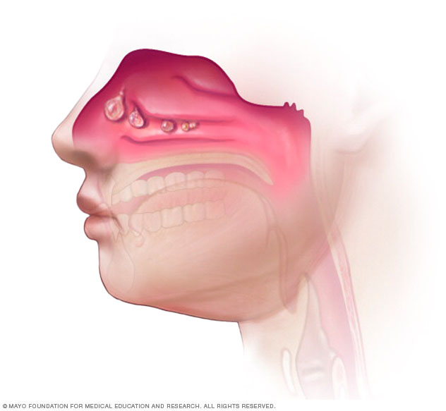 Nasal polyps in the nose and sinuses