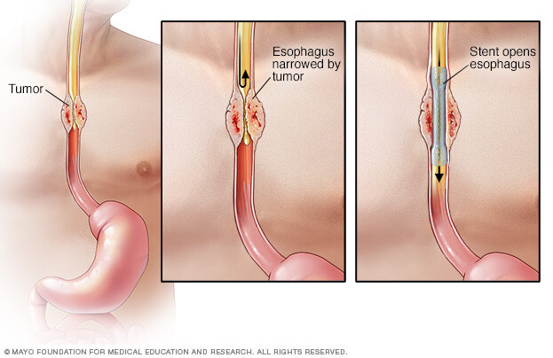 Esophageal stent