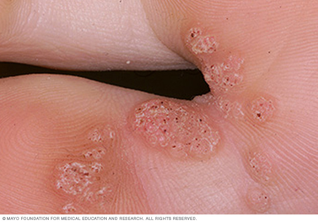 Plantar warts