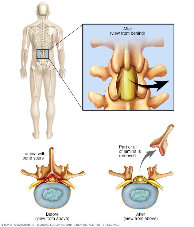 Removal of rear portion of a vertebra in lower back