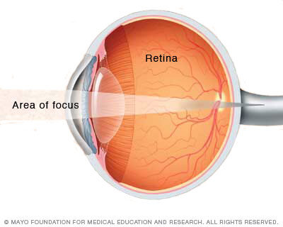 Farsightedness (hyperopia)