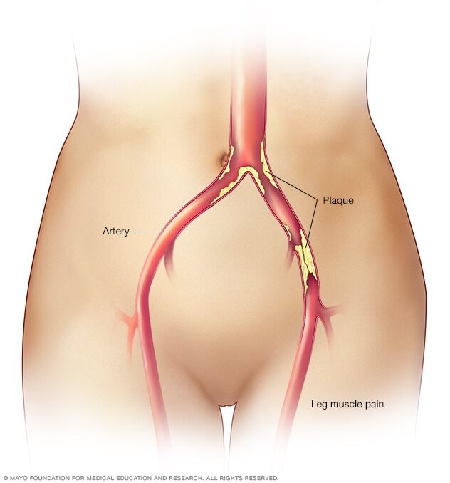 Claudication