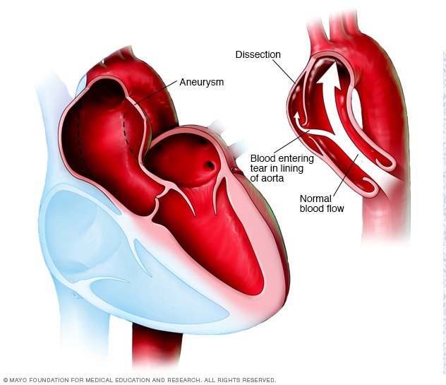 Aortic aneurysm and dissection