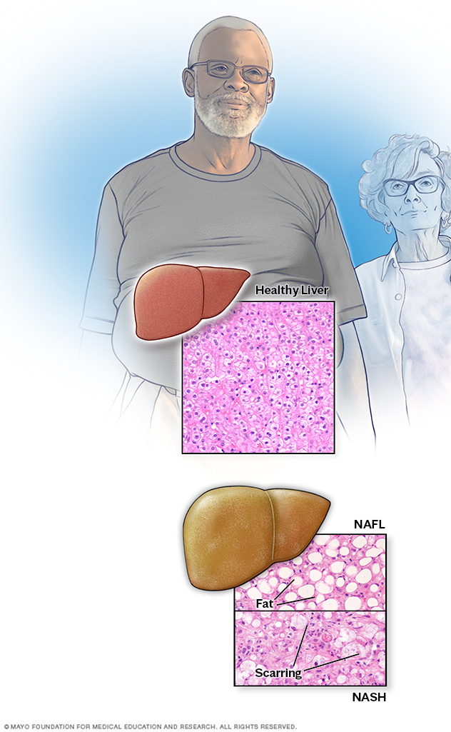 Microscopic view of healthy liver and nonalcoholic fatty liver