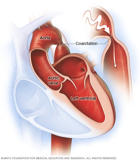 Coarctation of the aorta