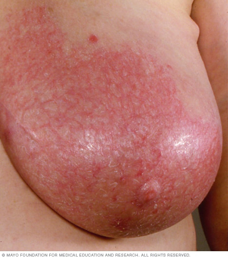 Person with mastitis in breast