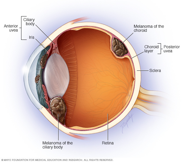 Illustration showing where eye melanoma occurs
