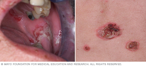 Pemphigus vulgaris of the mouth and skin 