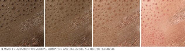 Contact dermatitis on four different skin colors.