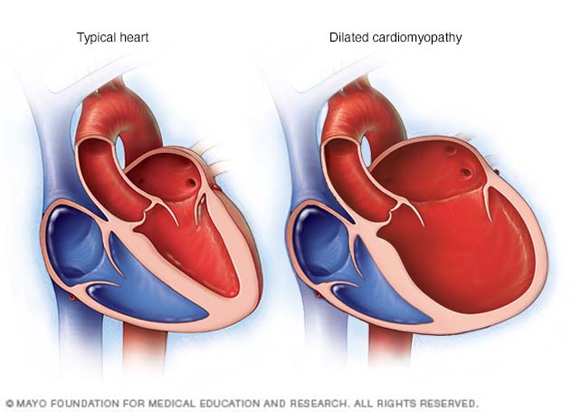 Dilated cardiomyopathy