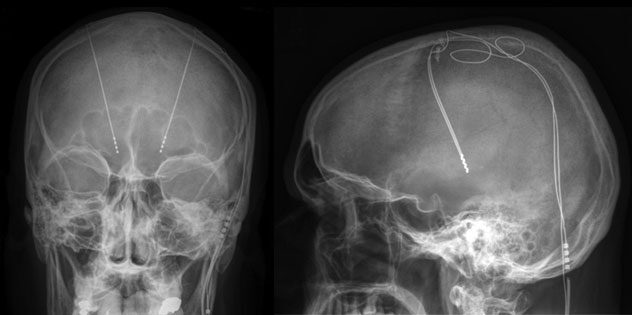 Deep brain stimulation