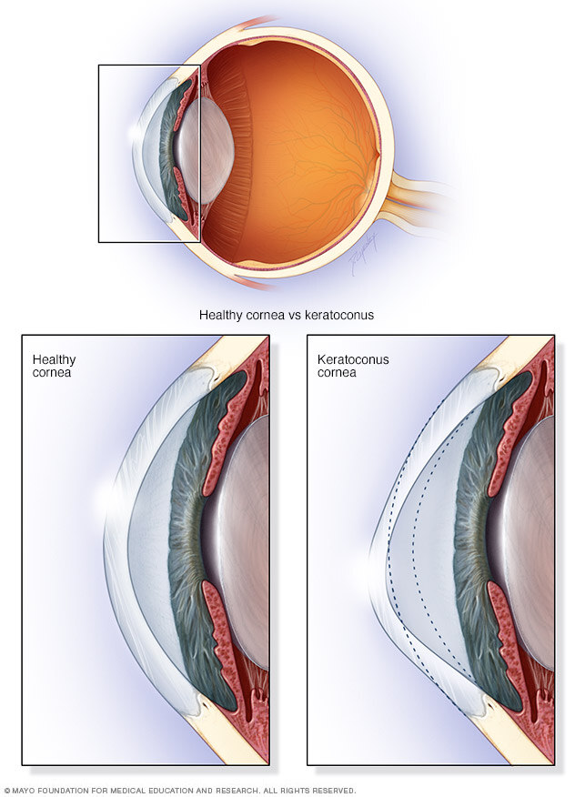 Keratoconus