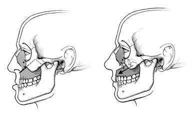 In upper jaw surgery, the surgeon makes cuts in the upper jaw, moves it forward, backward, up or down as needed and secures it with plates and screws. 