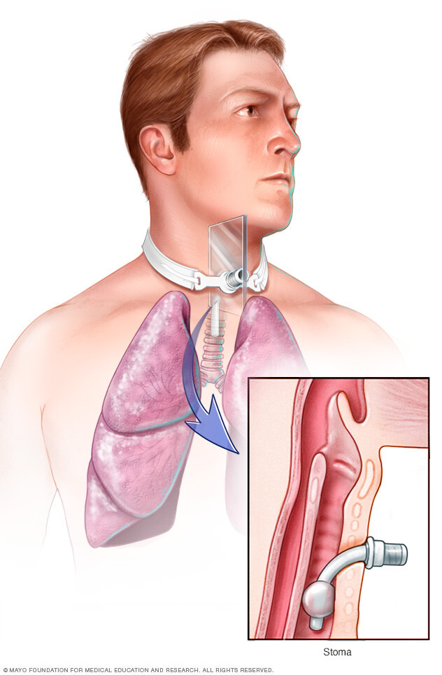 A tracheostomy tube