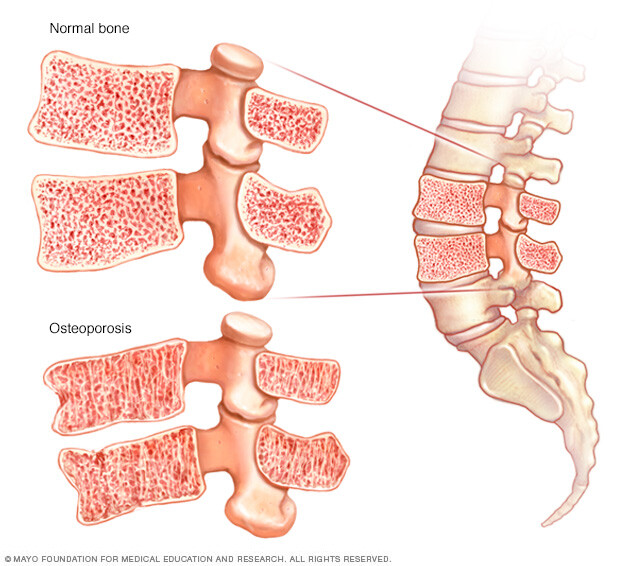 Normal bone and weakened bone