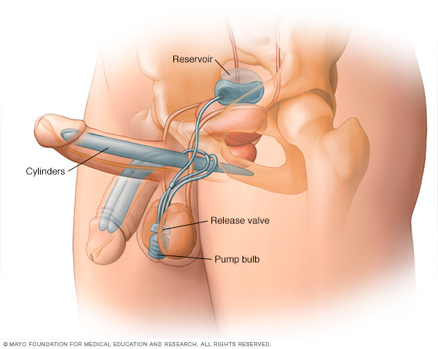 Three-piece penile implant