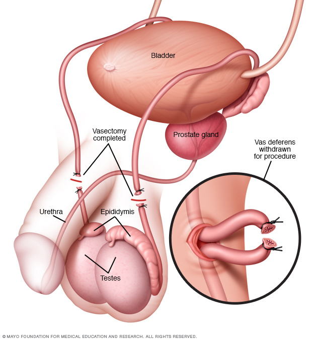 Vasectomy