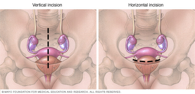 Vertical, horizontal abdominal hysterectomy incisions