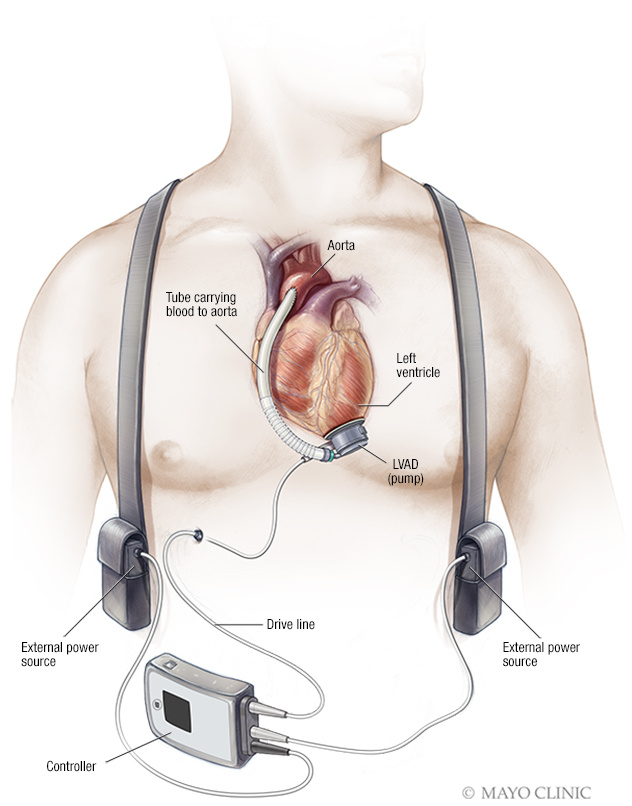 Left ventricular assist device (LVAD)