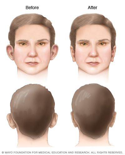 Otoplasty results