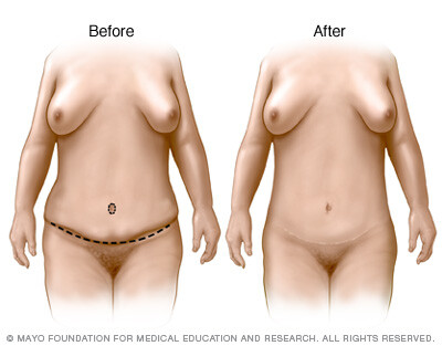 Tummy tuck results