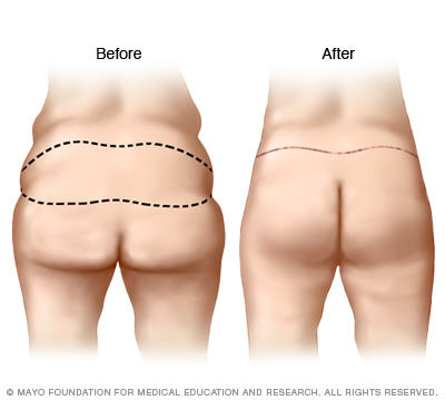 Illustration of buttock lift results 
