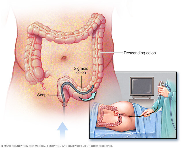 Flexible sigmoidoscopy exam