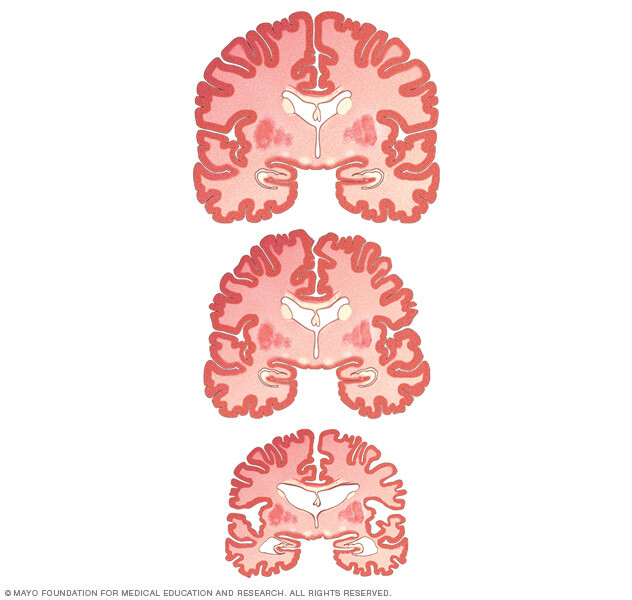 The difference in size between a healthy brain, an MCI brain and an Alzheimer's disease brain